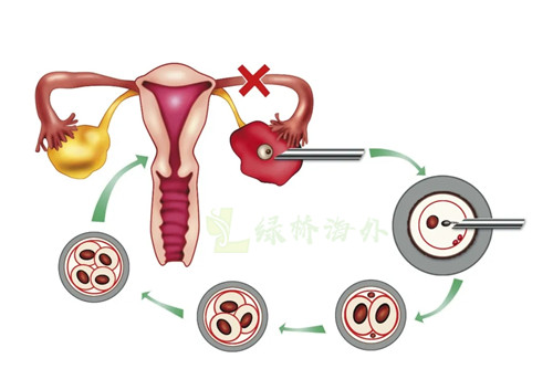 纵膈子宫和试管婴儿