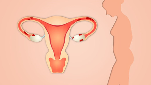 输卵管堵塞和试管婴儿